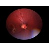Volk Pictor Portable Retinal Camera