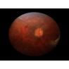 Volk Pictor Portable Retinal Camera