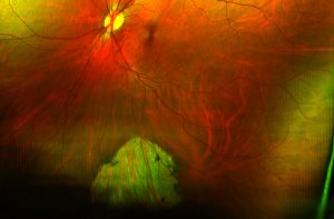 Chorioretinal atrophy