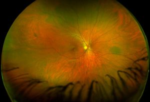 Color image of the Nevus