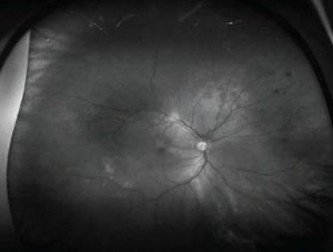 Green Melanoma
