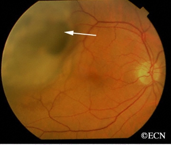 Color image of Melanoma
